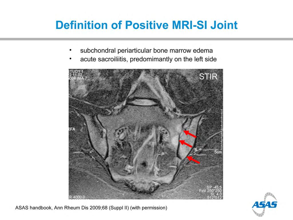 Definition of Positive MRI-SI Joint 13 13 ASAS