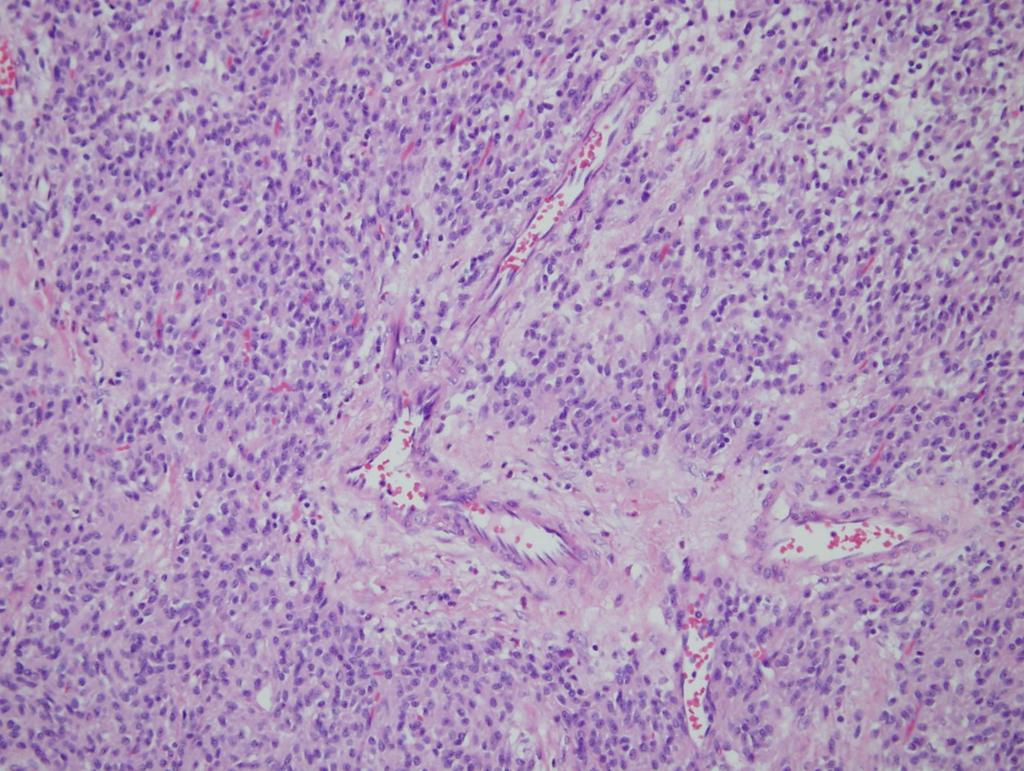 PDGFRA mutant GIST Gastric location, epithelioid morphology, often with