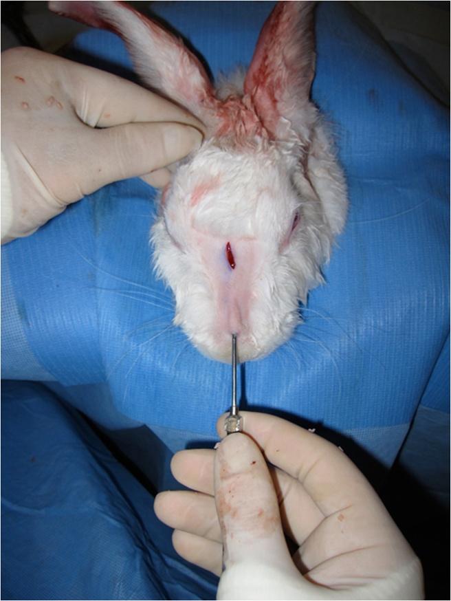 Figure 4 Injection of crushed cartilage graft in the inferior portion of the nasal dorsum. The critical step was crushing the remaining cartilage to produce an injectable slurry.