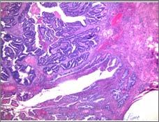 23 International Journal of Surgery Case Reports, Volume 22, 32-34. 60F with 4 yr h/o PMB. EMBX showed grade 2 endometrioid adenocarcinoma. Hysterectomy Grade 2 endometrioid adenocarcinoma 7.