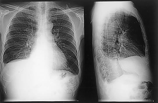 124 I. Kohno et al. CASE 1 A 64-year-old Japanese man was referred to our hospital because of general fatigue, dyspnea on effort, and pretibial edema in April 1997.