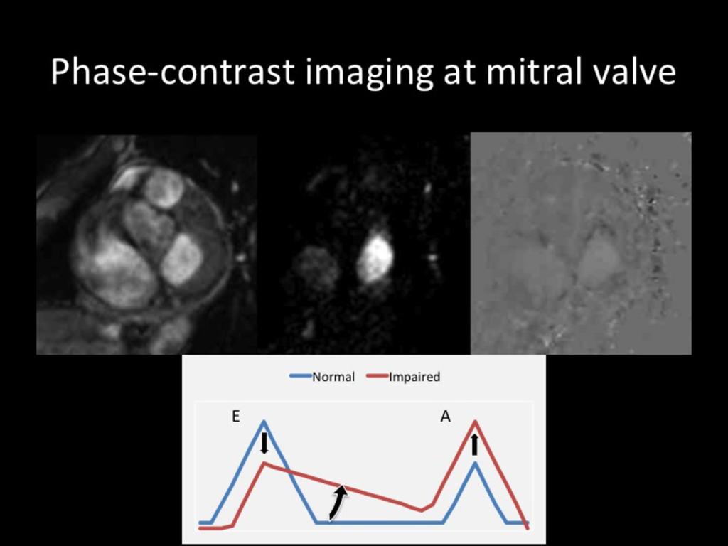 Fig. 7 T2-weighted imaging (T2WI) and T2 mapping T2WI can reveal the increase of the water component in the diseased myocardium.