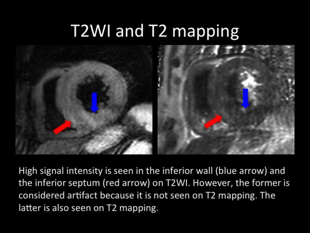 Fig. 8: High signal intensity is seen in the inferior wall (blue arrow) and the inferior septum (red arrow) on T2WI. However, the former is considered artifact because it is not seen on T2 mapping.