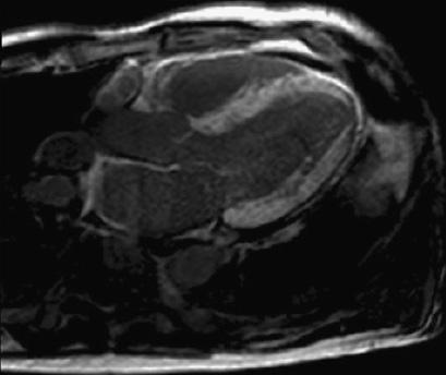 Cardiac MRI: Diffuse Late Gadolinium