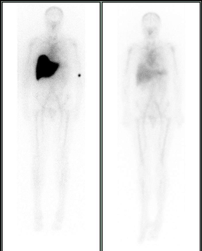 Anti-SAP antibody following depletion of circulating SAP with CPHPC SAP scintigraphy AL amyloidosis: Pt with large liver amyloid load.