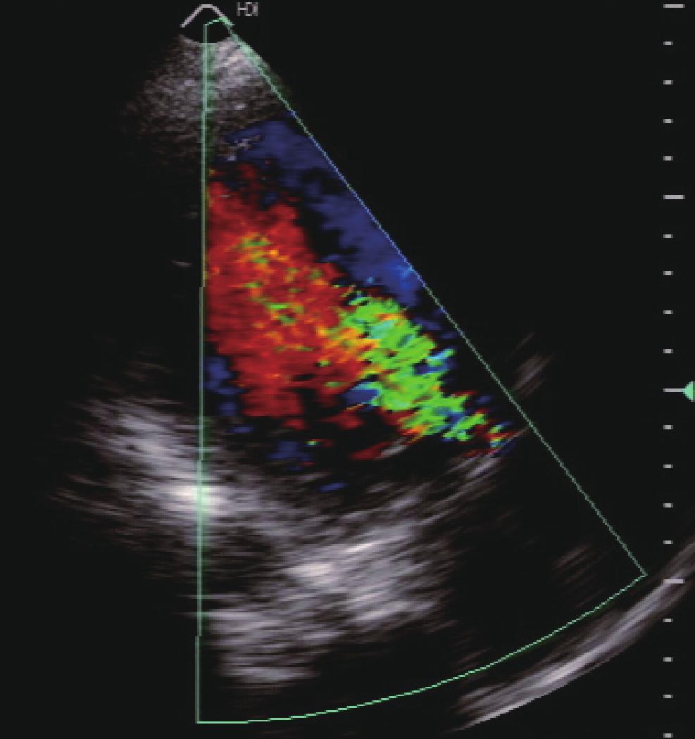 AR 4 Fig. 4. Color doppler echocardiography. The aortic valve was bicuspid. Color doppler echocardiography showed a severe aortic regurgitant jet.