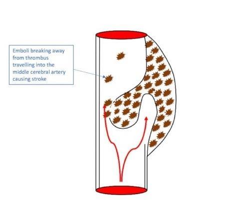 Figure 7: Thrombus formation and a subsequent increase in size within the false lumen can cause a reduction in blood