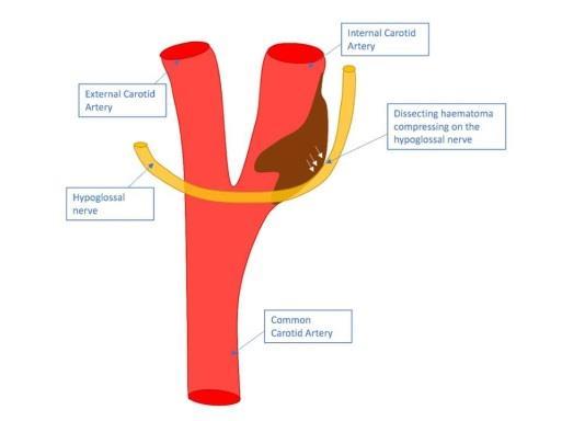 Figure 9: CNXII crosses the internal and external carotid arteries before moving anteriorly to enter the tongue.