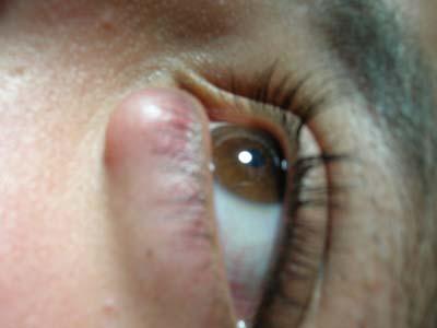 Recall signs of Malignancies 1) lash loss