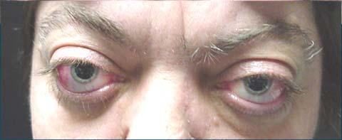 Bilateral Eyelid Retraction