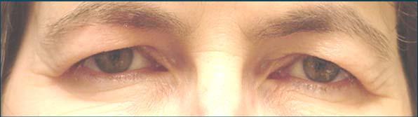 Without or With Upper Eyelid Ptosis