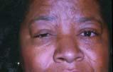 NF), Chalazion Excessive Dermatochalasis and/or