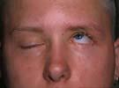 Don t Confuse with Lid Lag on Downgaze Congenital Ptosis Graves Ophthalmopathy