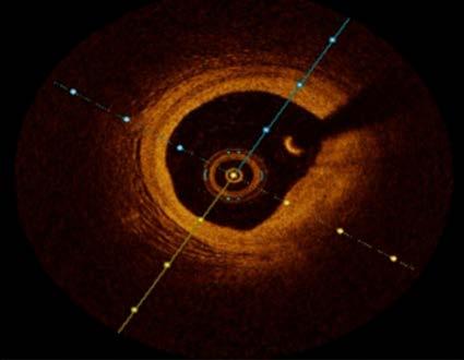 Articles excluded based on full-text analysis (n = 387) Reasons: IVUS only or IVUS/CT OCT only or OCT/CT Stable patients only Stable plaques only Case report, case series, review, letters Low number