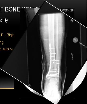 outcomes and expectations TYPES OF BONE HEALING Determined by mechanical stability Primary When