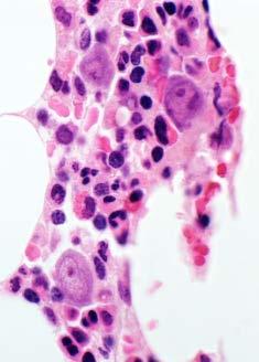 vascular disease Neoplasms T-cell LGL,