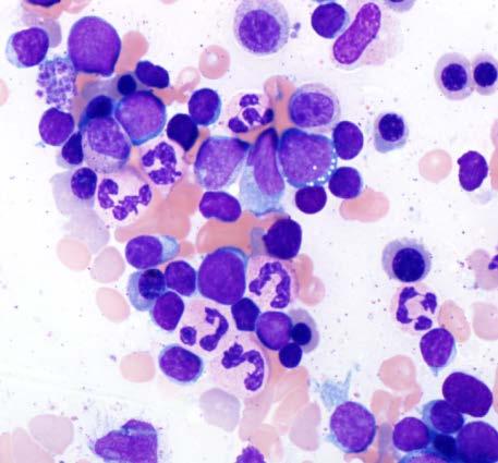Hematogones Normal B-lymphocyte precursors (arrows) May pose a diagnostic challenge with