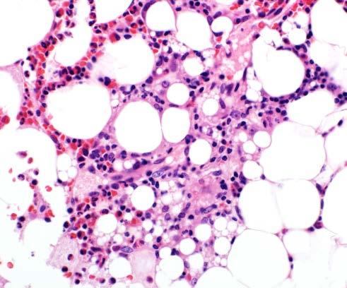 Histiocytic proliferations General increase Cell turnover Storage disorders Granulomas
