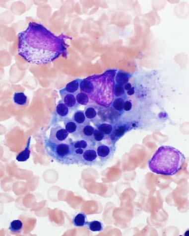 Hemophagocytosis Life-threatening condition characterized by overstimulation