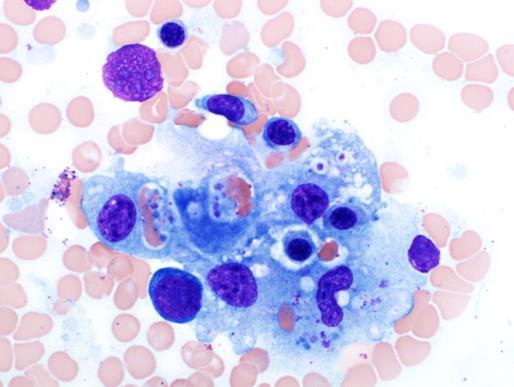 Hemophagocytosis Hemophagocytic syndromes are referred to as hemophagocytic lymphohistiocytosis (HLH)
