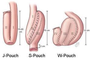 Types of pouch https://my.clevelandclinic.