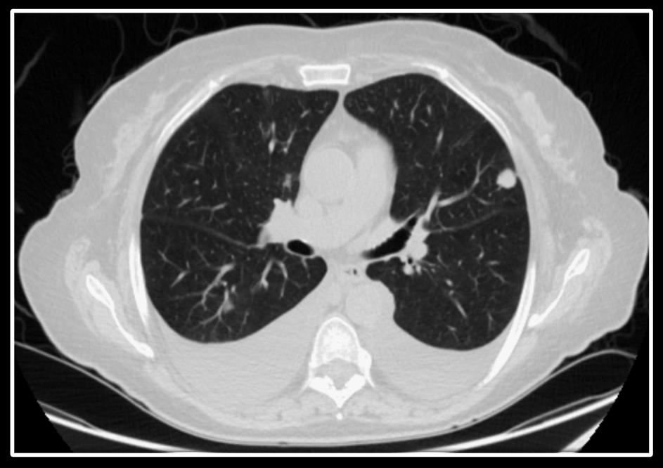 Improvement of Malignant Pleural Effusions and Ascites in Heavily Pre-Treated Patient with KRAS+ MSS