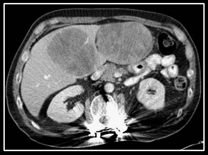Partial Response in Patient With Adrenocortical Carcinoma Treated With IPI-549 30 mg QD and