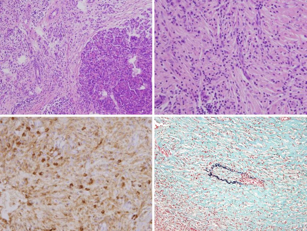 c d Figure 7. Histopthologicl findings of the gllldder tumor. () Inflmmtory cell infiltrtion with firosis (Hemtoxylin nd Eosin (H&E) stining, 100).