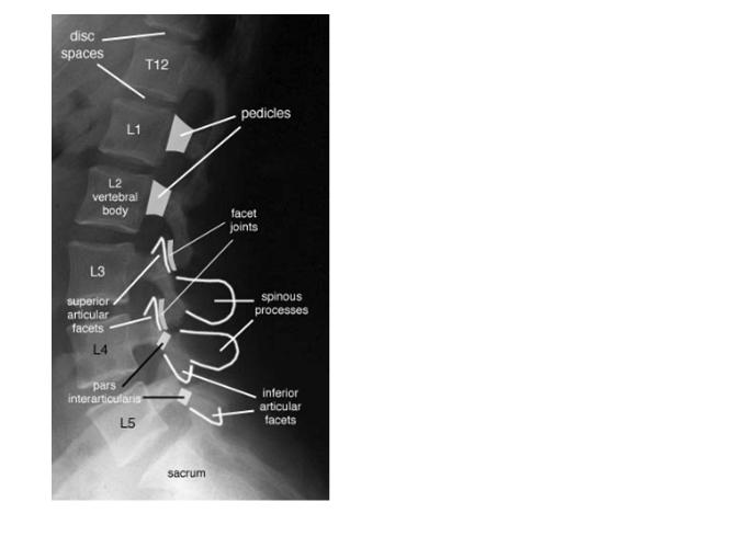 Spondylolysis Repetitive exposure to simultaneous forces of muscle contraction, gravity and rotational forces Repeated micro fractures of the pars interarticularis Classic imaging -