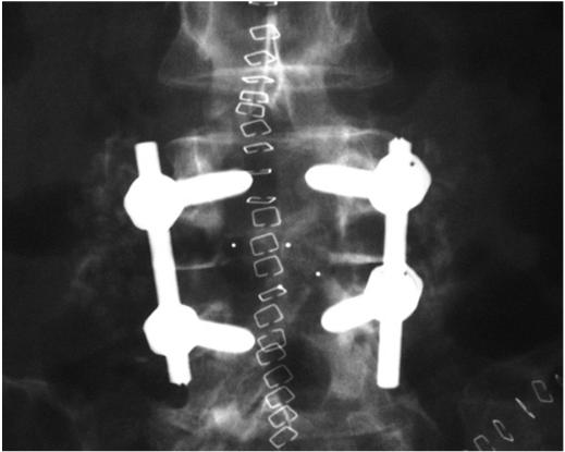 with compression of the thecal sac (1-2% of disc herniations) Cauda Equina syndrome outcome following