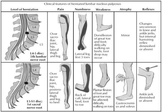 quadricep weakness, iliopsoas L5 Foot dorsiflexion, eversion,