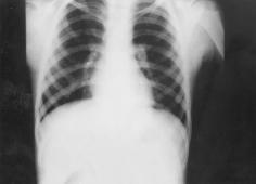 Volüm 9 Say 1 FOREIGN BODY ASPIRATION: A 4-YEARS' EXPERIENCE 47 Picture 3. X-ray of a patient showing unilateral air trapping Picture 4.