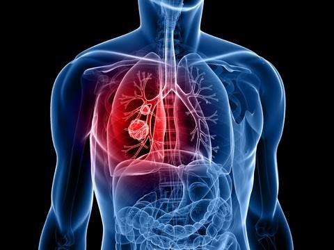 Lung cancer In Malaysia, lung cancer accounts for 13.8% of all cancers in males and 3.
