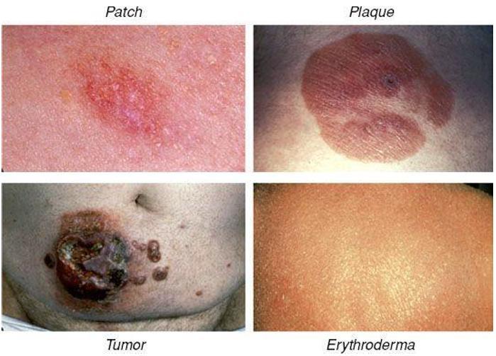 Sezary syndrome: similar to MF with the addition of generalized exfoliative erythroderma and circulating tumour cells in