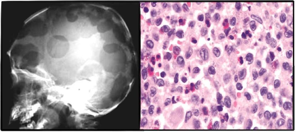 Remember that: plasma cell myeloma doesn t occur in young patients, while histiocytosis occurs in very young patients. Both cause lytic lesions especially in the skull. Morphology: *Lytic lesions.