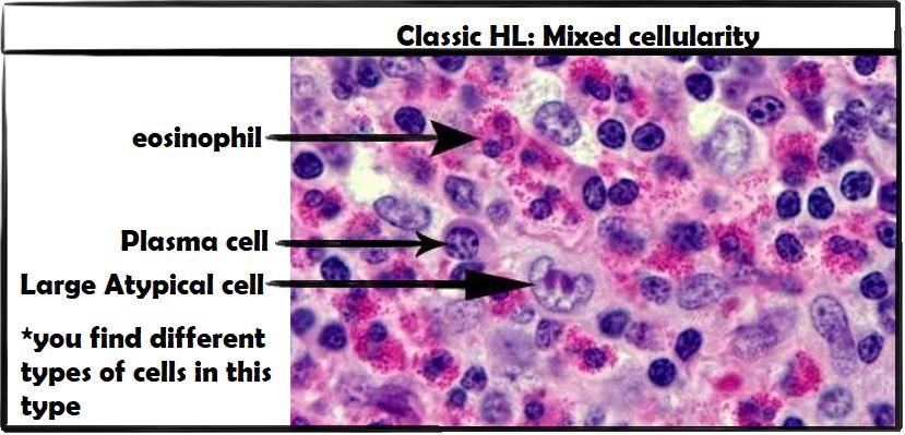 Immunophenotype Classic HL NLP HL CD30+, CD15+.