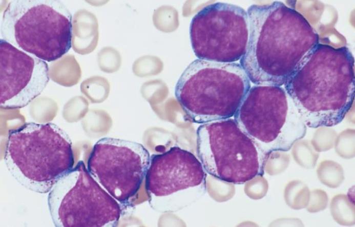 WHO 2008 AML CLASSIFICATION Bone marrow blast cells