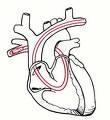 Hemodynamic monitoring Swan-Ganz: pulmonary artery