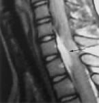 Thoracic epidural analgesia Haematoma formation in the spinal canal due to epidural anesthesia is a serious but very rare complication.
