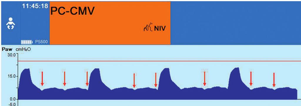 VOLUME GUARANTEE 03 D-45978-2015 Figure 1: Graphical representation of airway pressure in the patient during NIV with the Babylog VN500 The red arrows in Figure 1 indicate small depressions in the