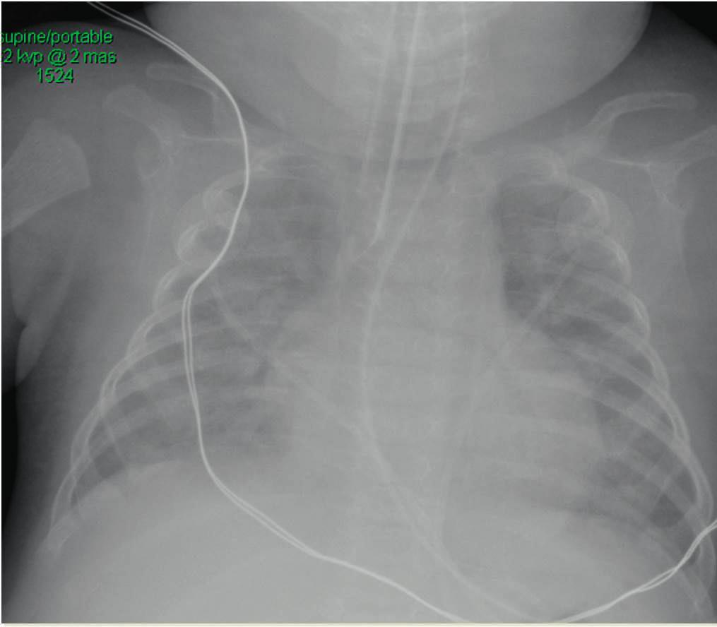 04 VOLUME GUARANTEE D-45979-2015 Figure 2: X-ray after intubation The application mode was changed to tube for invasive ventilation.