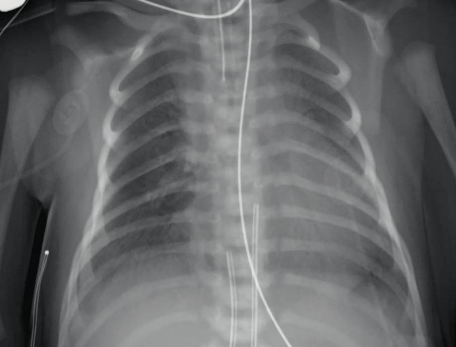 ventilator (Figure 4A). The chest x-ray showed low lung volumes with increasing atelectasis and air bronchograms (Figure 4B) from the previous exam.