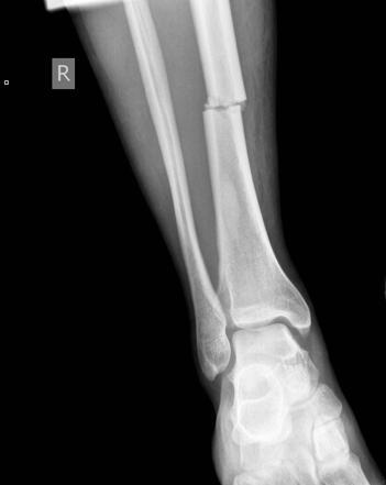 Background 5% of pediatric fractures occur at tibia [1] Tibia is a load bearing bone Correct alignment is essential [2] Many bone