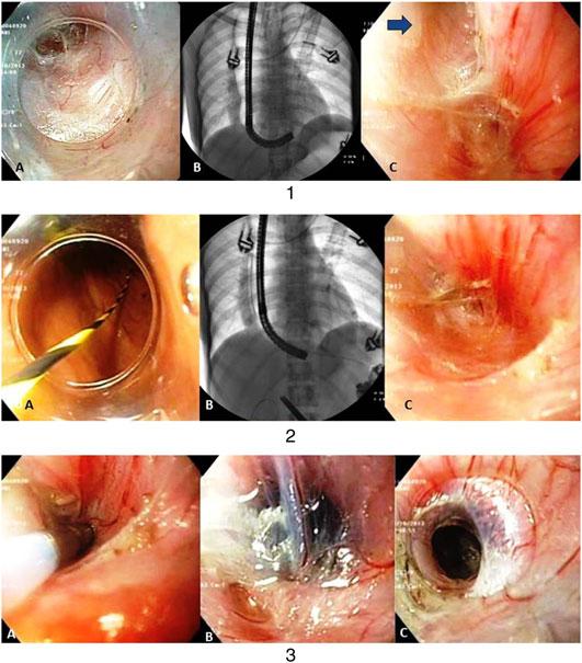 22 M. Ramchandani et al. Digestive Endoscopy 2016; 28: 19 26 Figure 1 (Panel 1) (A) Endoscopic picture showing submucosal tunneling in a patient with sigmoid esophagus.