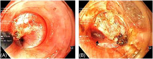 (B) Correction of scope direction in the submucosal tunnel according to the guidewire. (C) Endoscopic view of correct direction of tunneling.