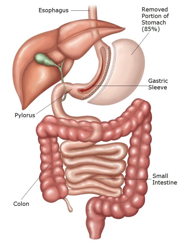 Gastrectomy (VSG)