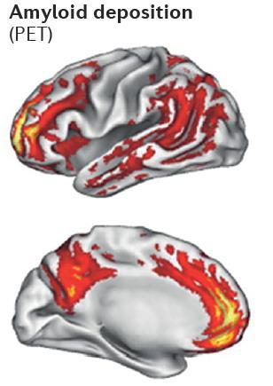 Amyloid deposits (red) predominate in brain regions of the