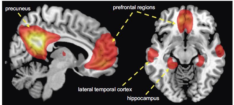 Brain regions within the default mode network are particularly vulnerable to aging and dementia.