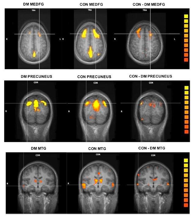 medial frontal gyrus precuneus middle temporal gyrus T2DM patients showed reduced functional connectivity in the default mode network compared with control
