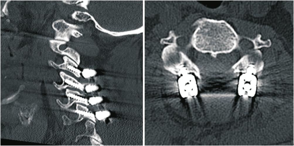 Gábor Czigléczki et al./ Journal of Acute Disease (2014)265-271 267 consequences are the postlaminectomy kyphosis that may lead to the recurrence of CM, spine deformity and neck pain[17-19].